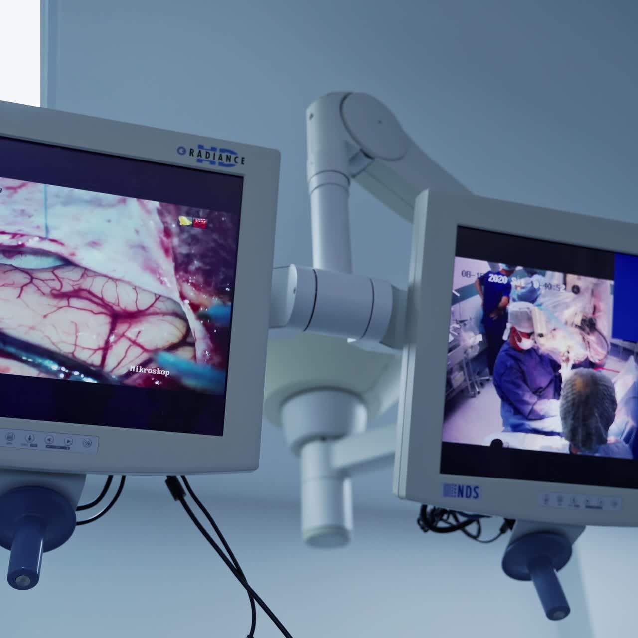 Neurosurgical process displayed on screen. Modern equipment in the operating room. Surgery demonstration on monitor.