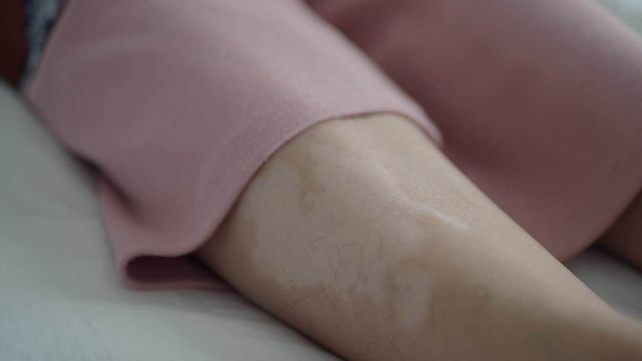 cerca de la pierna de una mujer con una cicatriz