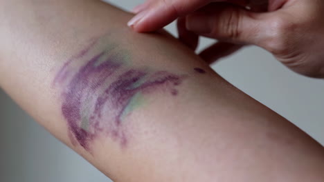 bruise on arm
