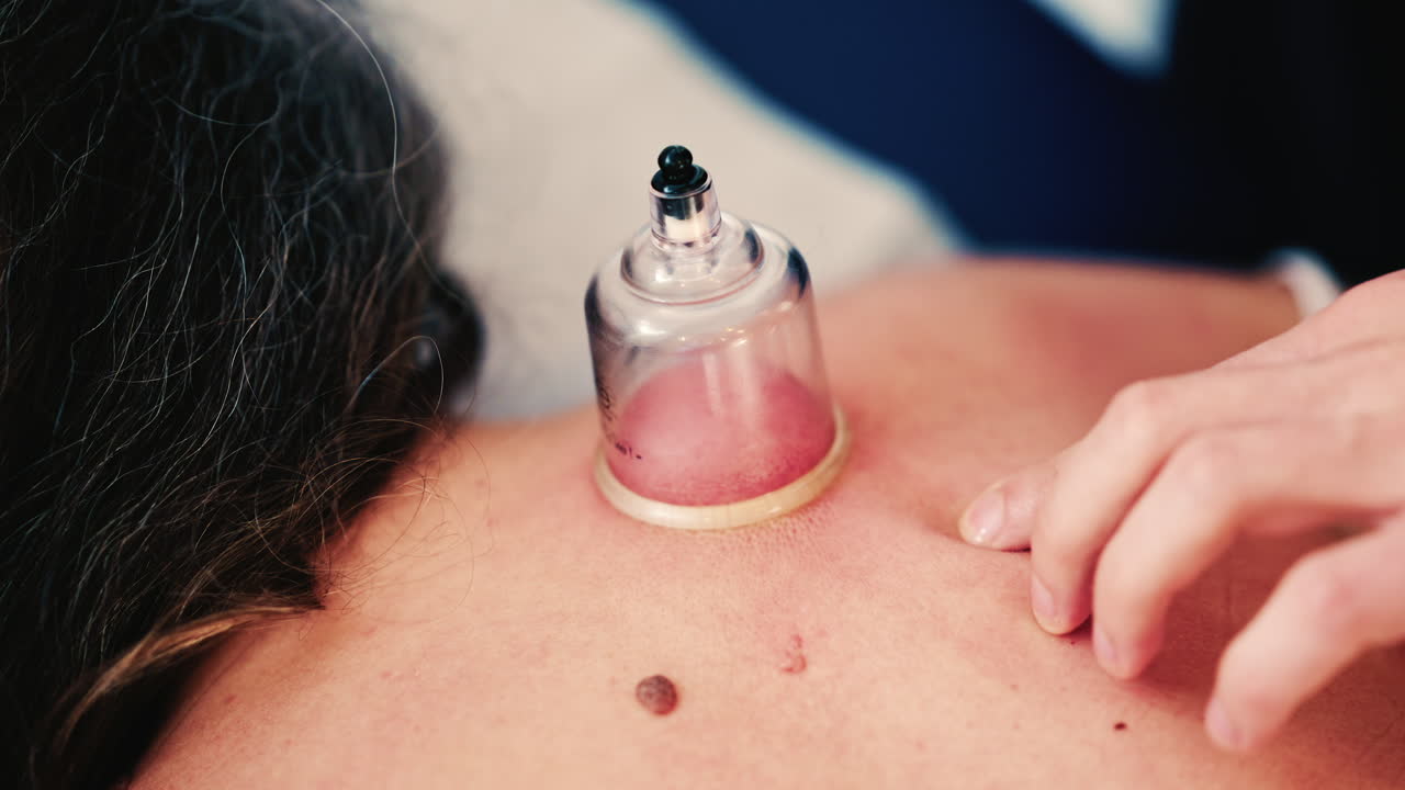 Close up of vacuum cupping therapy being applied to a woman's upper back in a clinical wellness setting