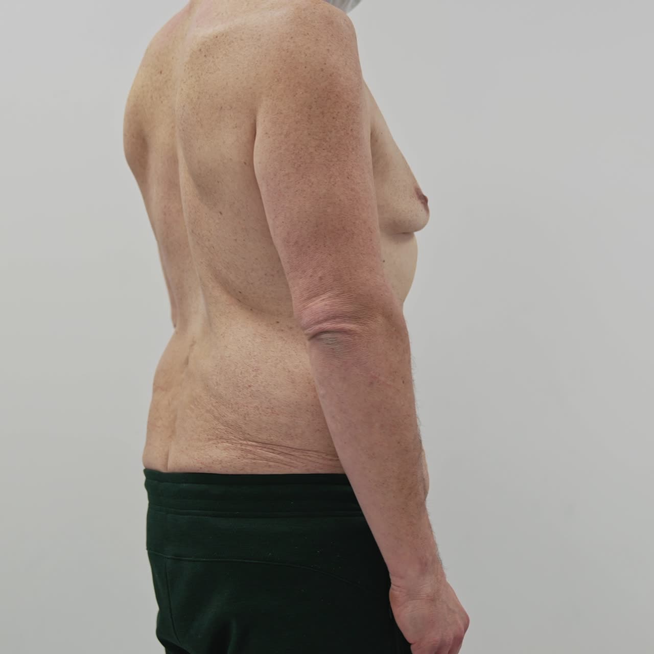 Dropping body of a male patient in clinic. Shirtless man showing his body with problem zones to the plastic doctor in clinic. Body after weight loss