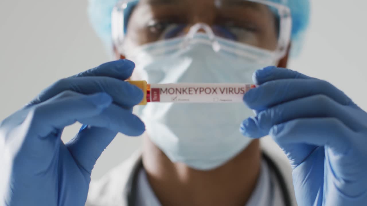 médico afroamericano de sexo masculino con máscara facial, sosteniendo un vial con el virus de la viruela del mono