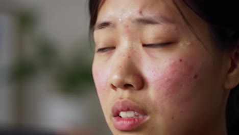 a young woman with a worried expression sits indoors, revealing signs of distress. her skin reflects health struggles as she appears deep in thought, conveying a sense of vulnerability and emotion.