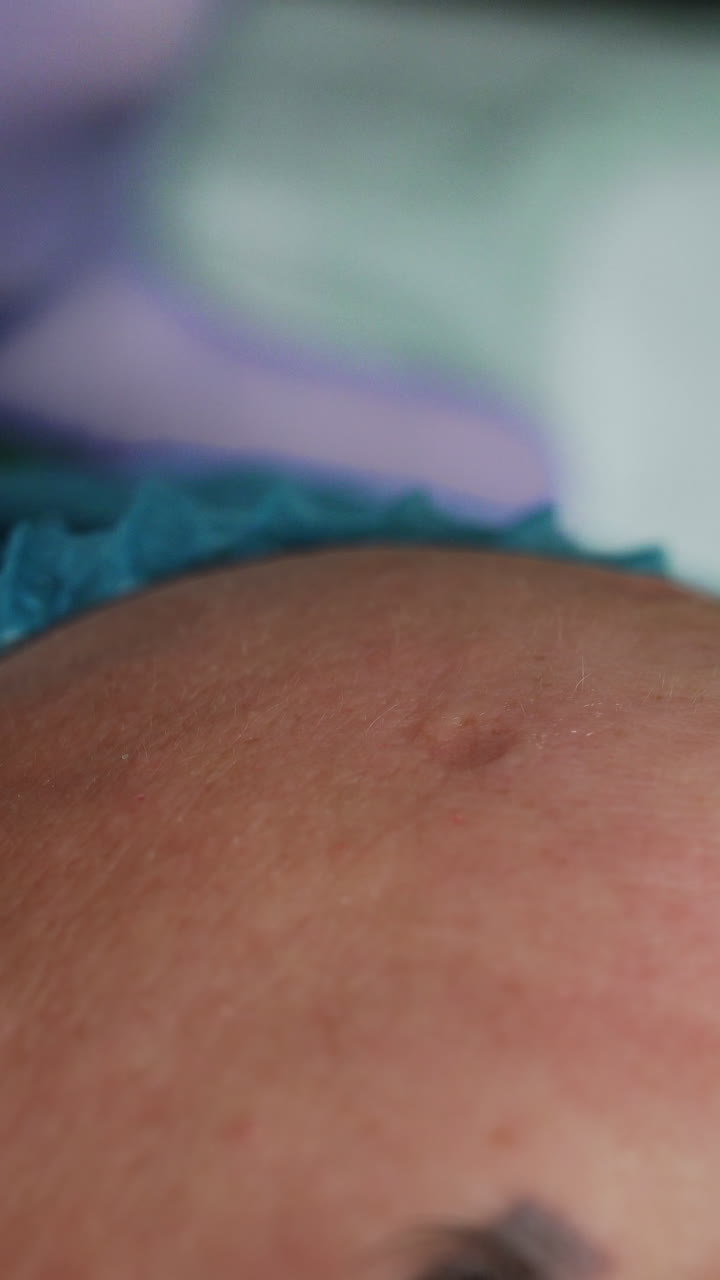 Cosmetologist applies tool for blackhead removal on client's forehead. Beauty and skincare procedures. Extreme close up. Vertical video