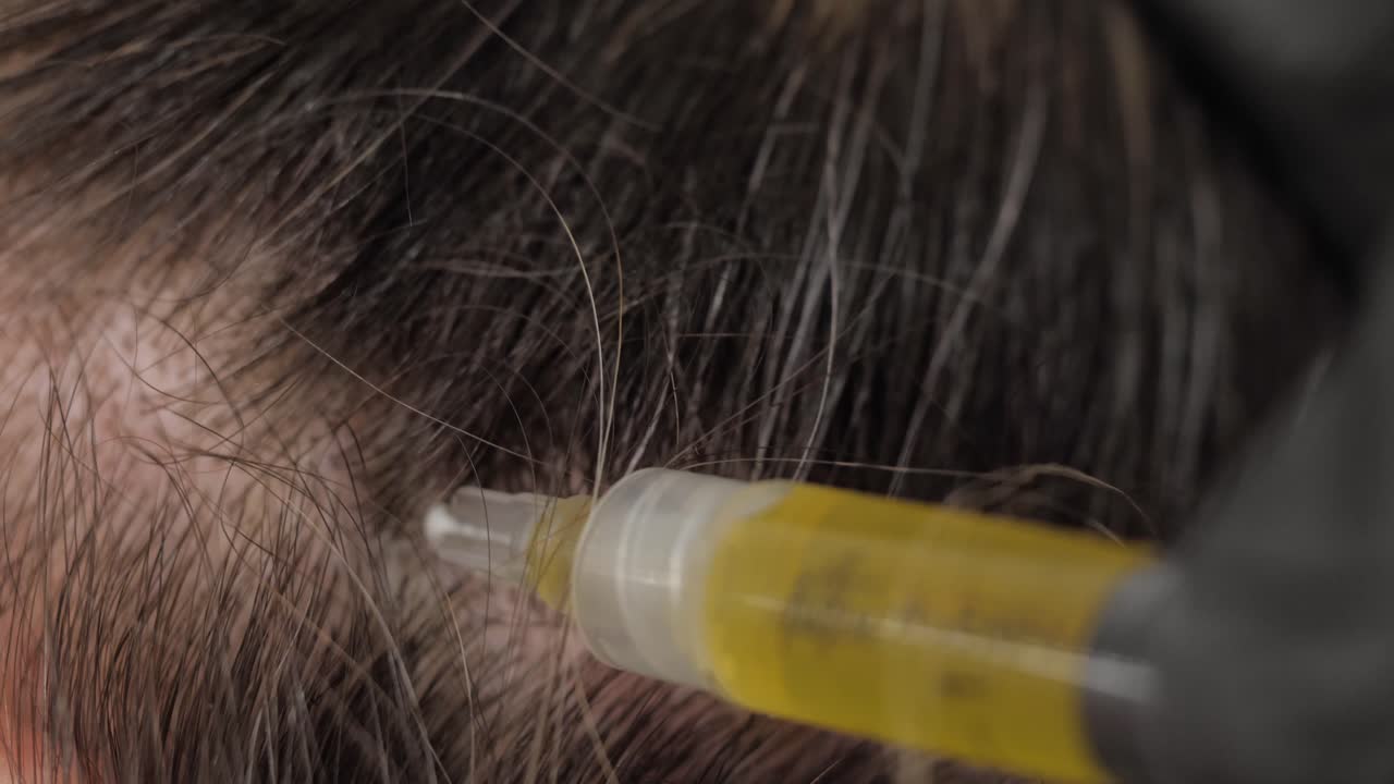 탈모 치료 절차