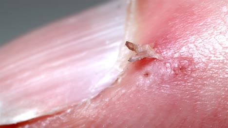 fingernail health problem: close up view of hangnail skin detail