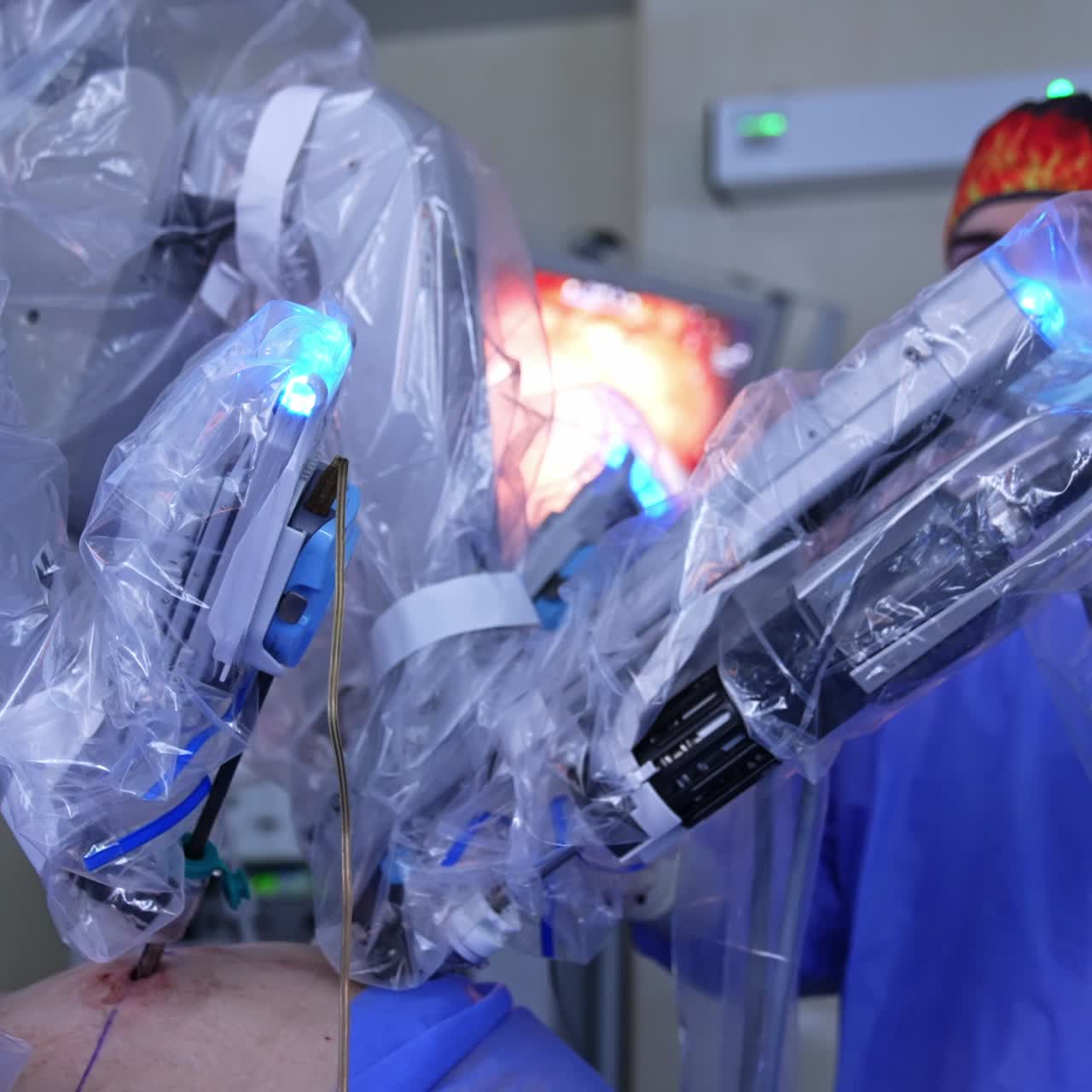Manipulator active arms perform abdominal surgery. Young male surgeon watches the procedure carefully