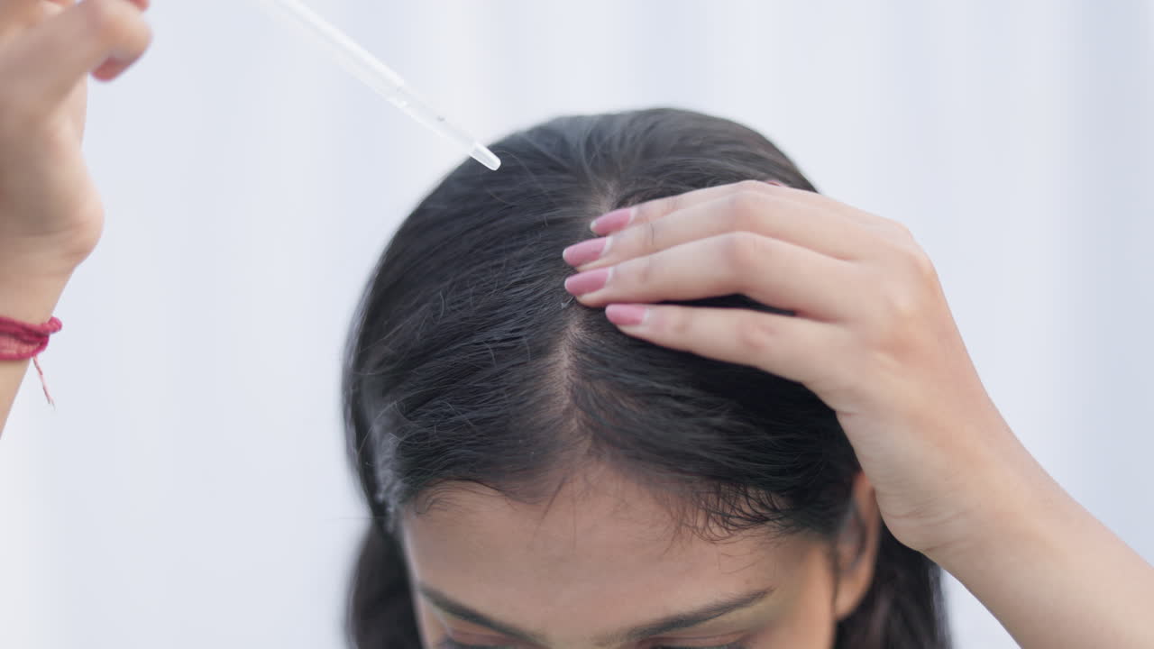 A young woman with a dropper applying minoxidil on bald area to treat androgenic alopecia, female pattern baldness, hairloss, close up shot.