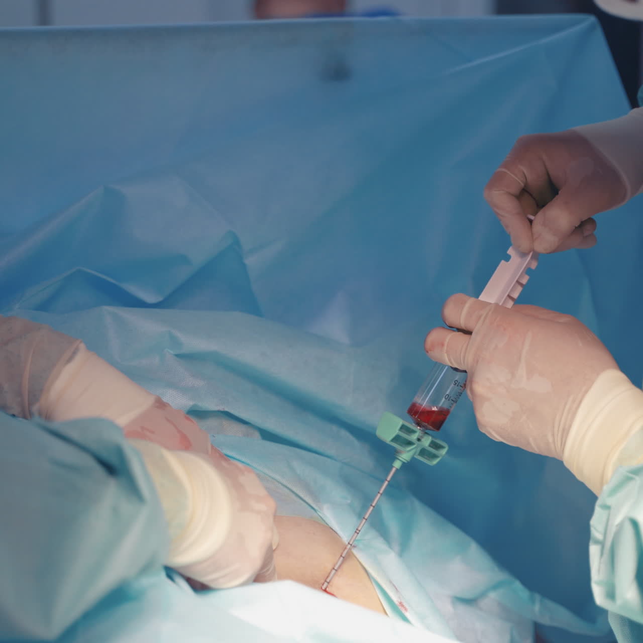 Bone marrow transplant operation. Team surgeons operation bone marrow transplant