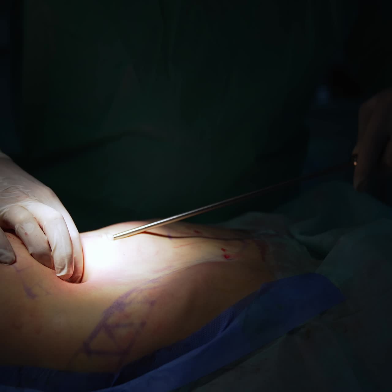 Fat removal surgery. Doctor's hands on abdomen of a patient during liposuction procedure. Detailed surgical process. Close-up
