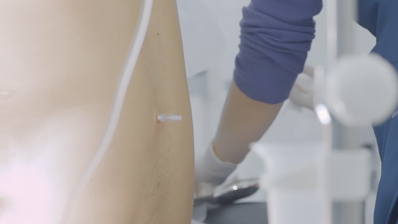 iv procedimiento de inserción