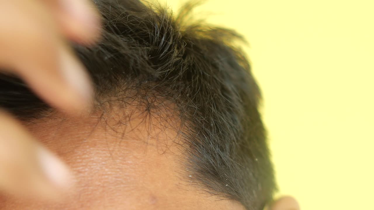 머리카락이 빠지는 남자