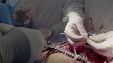 medical staff of the operating unit do heart surgery the nurse assists in performing the operation preparing to install a shunt