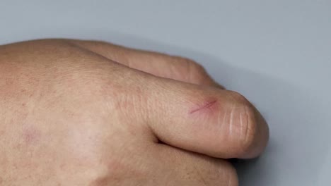 A series of images showing the healing progression of a small cut on a finger.