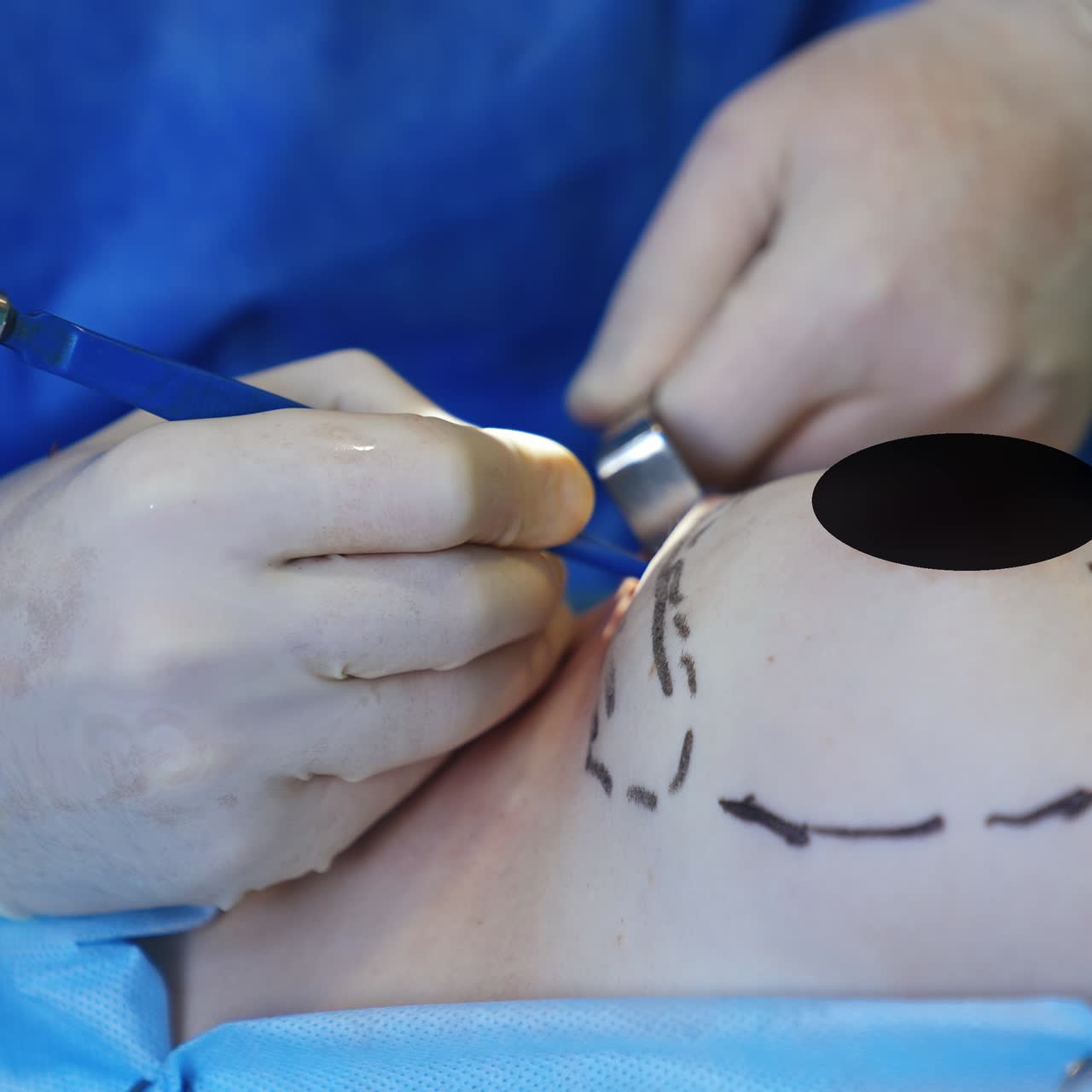 Hands of surgeon in latex gloves use tools at patient's breast with implant inside. Close up. Breast enlargement in modern clinics
