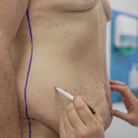 surgeon prepares man's stomach for body lifting. doctor's hand marking problem parts of a patient's belly with a marker before the plastic surgery. close-up. side view