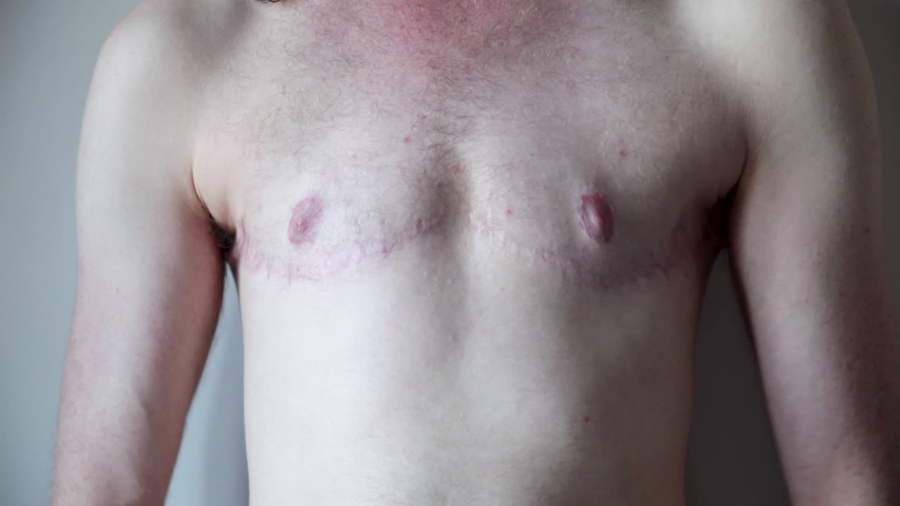 Transgender Man showing Surgery Scars on Chest