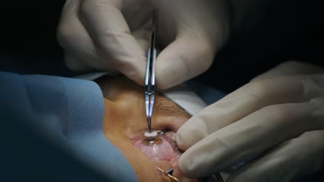 laser vision correction. a patient and team of surgeons in the operating room during ophthalmic surgery. eyelid speculum. lasik treatment. patient under sterile cover