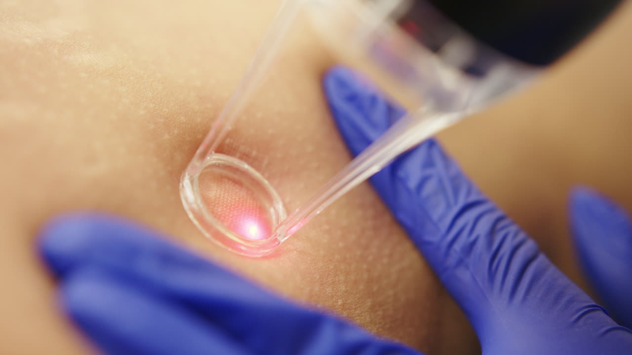 procedimiento de tratamiento cutáneo con láser