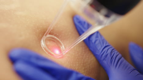 laser skin treatment procedure