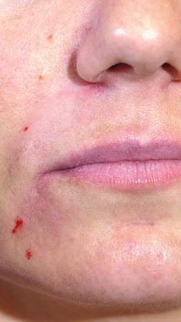 close-up of skincare treatment being applied to a woman's face, highlighting the process of acne treatment and skin rejuvenation in a clinical setting