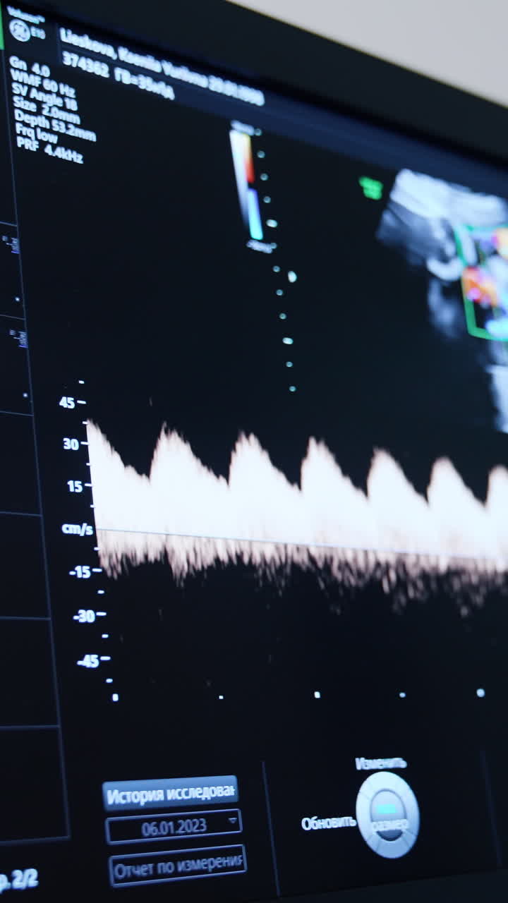 Heartbeat rate line shown on the screen of ultrasound machine. Close up. Pregnancy examination in the hospital. Vertical video