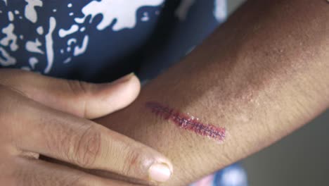 herida cosida en el brazo
