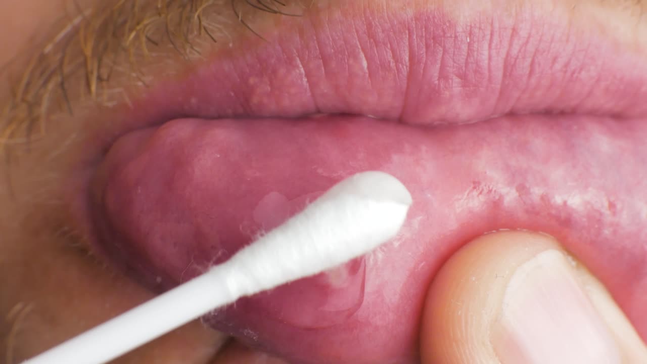 putting healing gel ointment on an aphtha oral inflammation on the gums with a cotton swab CLOSE UP
