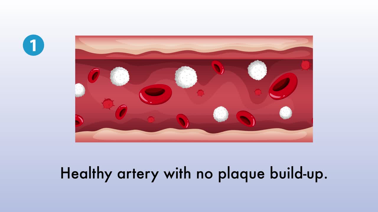 시간이 지남에 따라 동맥의 동맥 경화의 시각적 단계.