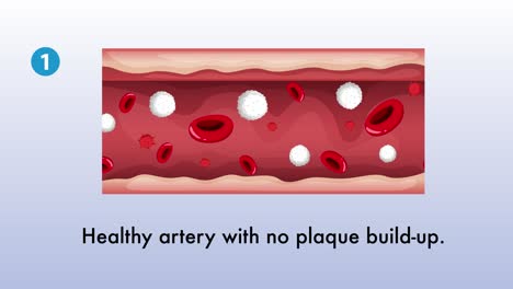 visual stages of atherosclerosis in an artery over time.