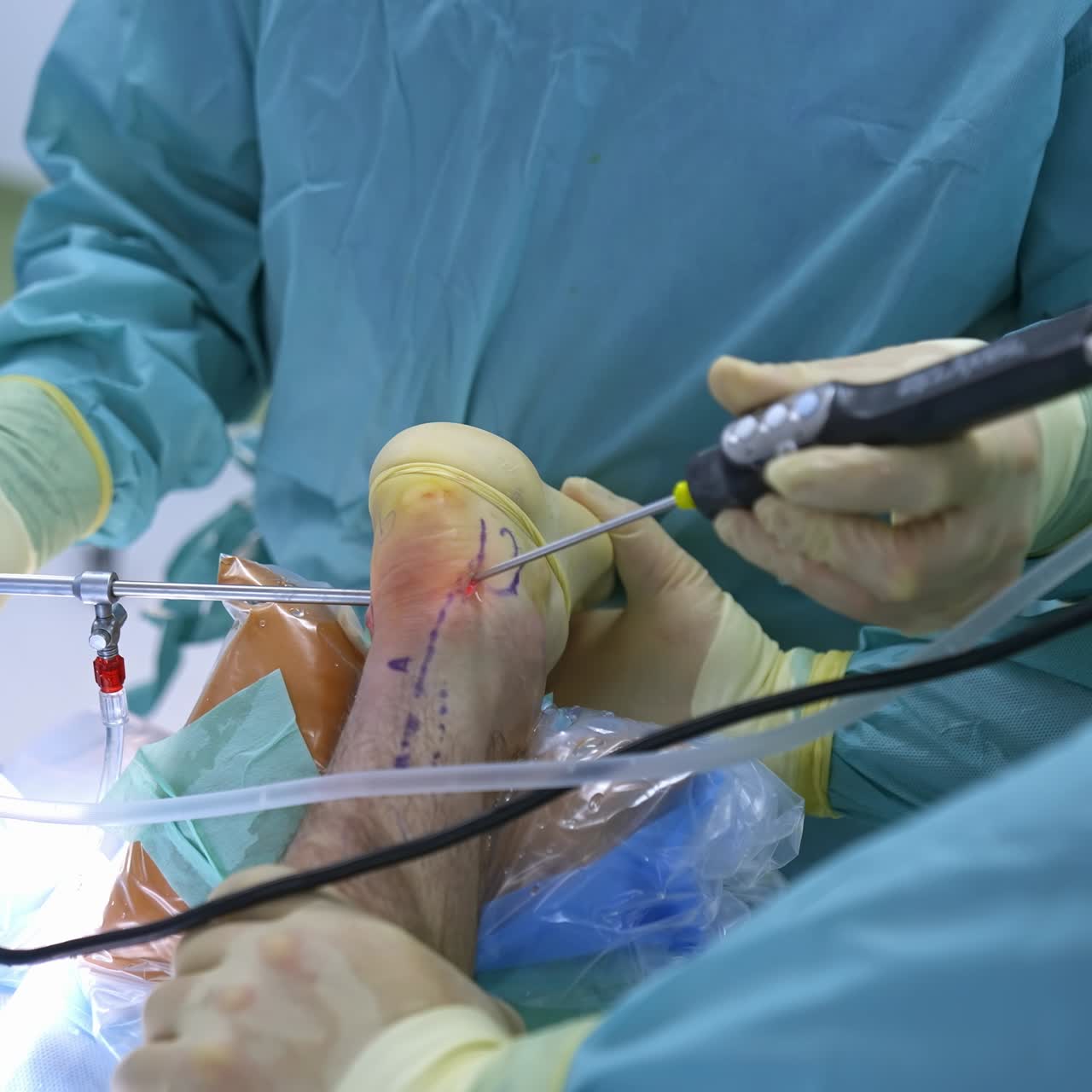 Group of surgeons in operating room with surgery equipment. Process of trauma surgery operation