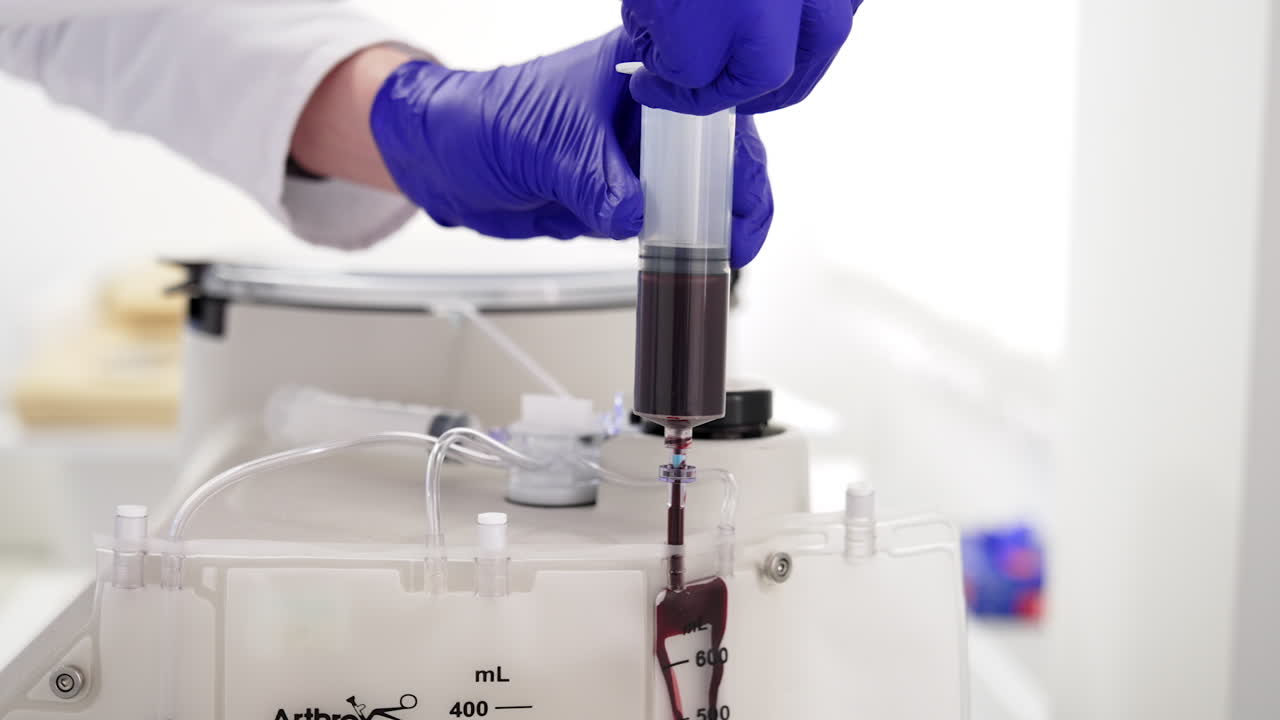Hands in blue latex gloves putting blood from a large syringe into the centrifuge device. Preparation for separating plasma from blood. Close up.