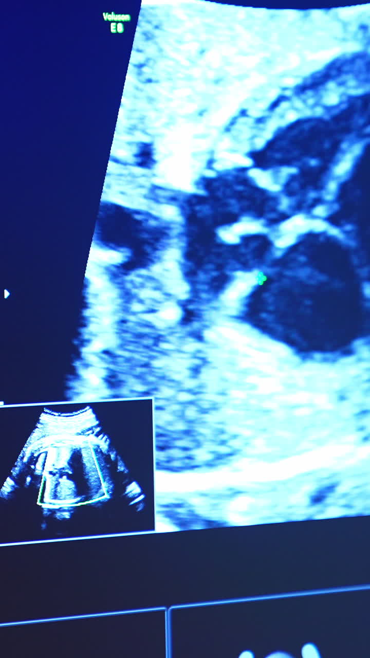 Schermo blu di un ecografo che mostra l'addome di una donna incinta. Medico che controlla le condizioni della gravidanza. Video verticale.