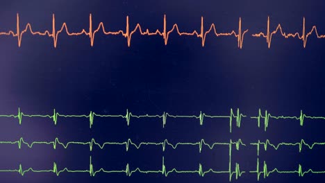cardiograma real. el cardiógrafo osciloscopio muestra el ritmo cardíaco en una pantalla.