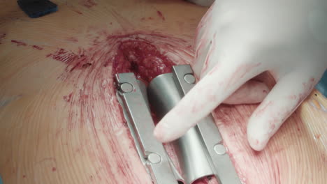 doctor operates using surgical dilator. surgeon meticulously uses medical tool to perform coronary artery bypass ensuring smooth and safe medical procedure