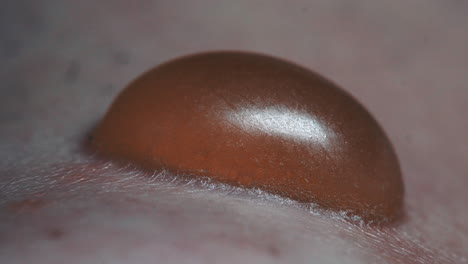 primer plano de una ampolla dolorosa extrema infectada con pus, tratamiento médico y paciente dermatólogo