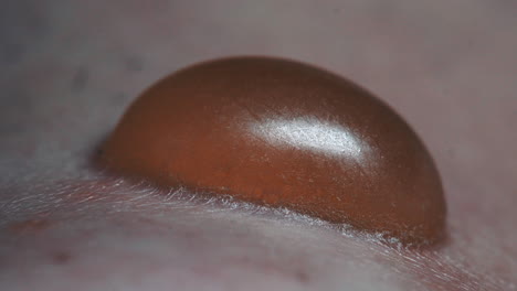 closeup of extreme painful blister infected with pus, medical treatment and dermatologist patient