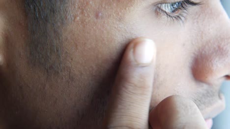 man with acne scars and skin discoloration