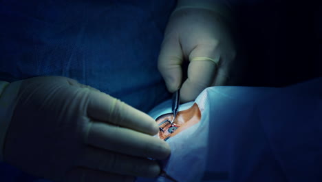 laser vision correction surgery. surgeon operating eye of patient at the operating room