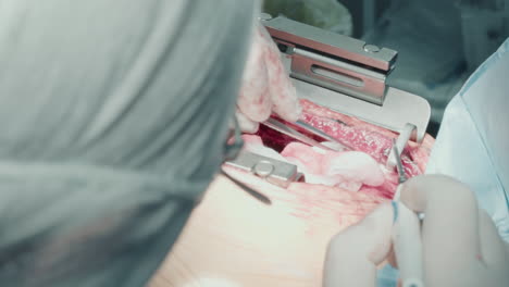 doctor shows expertise during surgery. surgeon uses forceps to handle sponge during meticulous coronary artery bypass surgery in clinic operating room