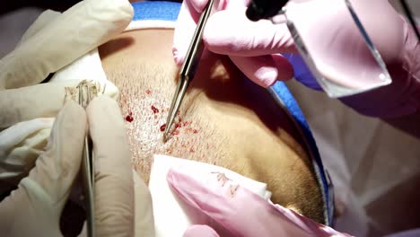 primer plano de los folículos pilosos recolectados individualmente de la barba del paciente durante el procedimiento de trasplante fue