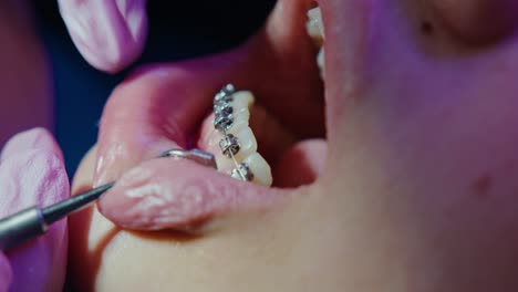 orthodontist dentist securing self-ligating braces, close up