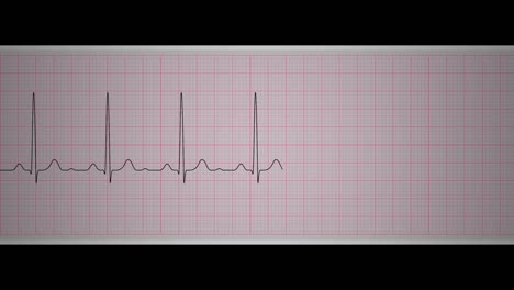 ekg normal sinus