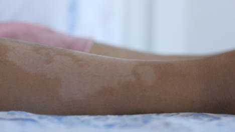 close-up photo of a human leg with a skin condition