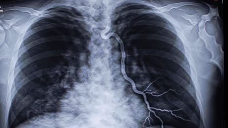 this visual representation showcases a chest x-ray highlighting the heart, lungs, and vascular structure. the detailed imaging provides insights into respiratory and cardiovascular health.