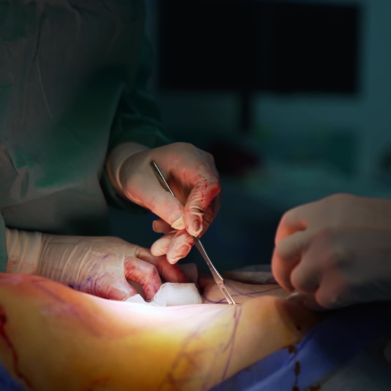 Body correction. Surgeons in medical gloves doing plastic surgery on abdomen using surgical instrument. Liposuction procedure in light spot. Abdominoplasty