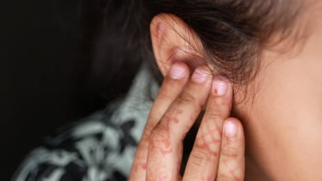 a woman's hand touching her ear, with signs of rashes or psoriasis on the hand.