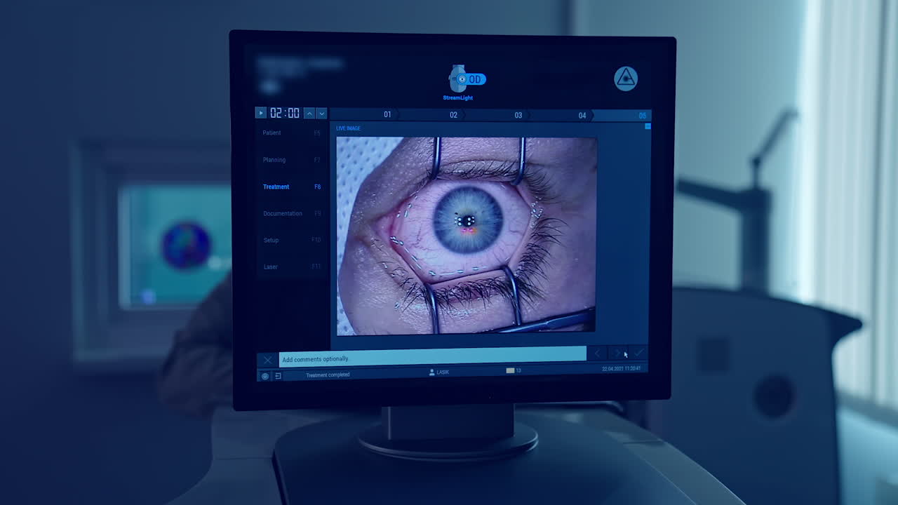 Computer monitor with eye surgery getting shown. Eye getting wiped while being operated. Eye laser treatment on a screen. Close-up.