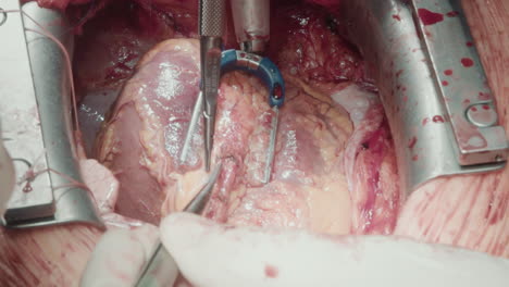 surgeon uses micro forceps operating on beating heart. hand of medic performs surgery with specialized instruments for working on small coronary arteries closeup