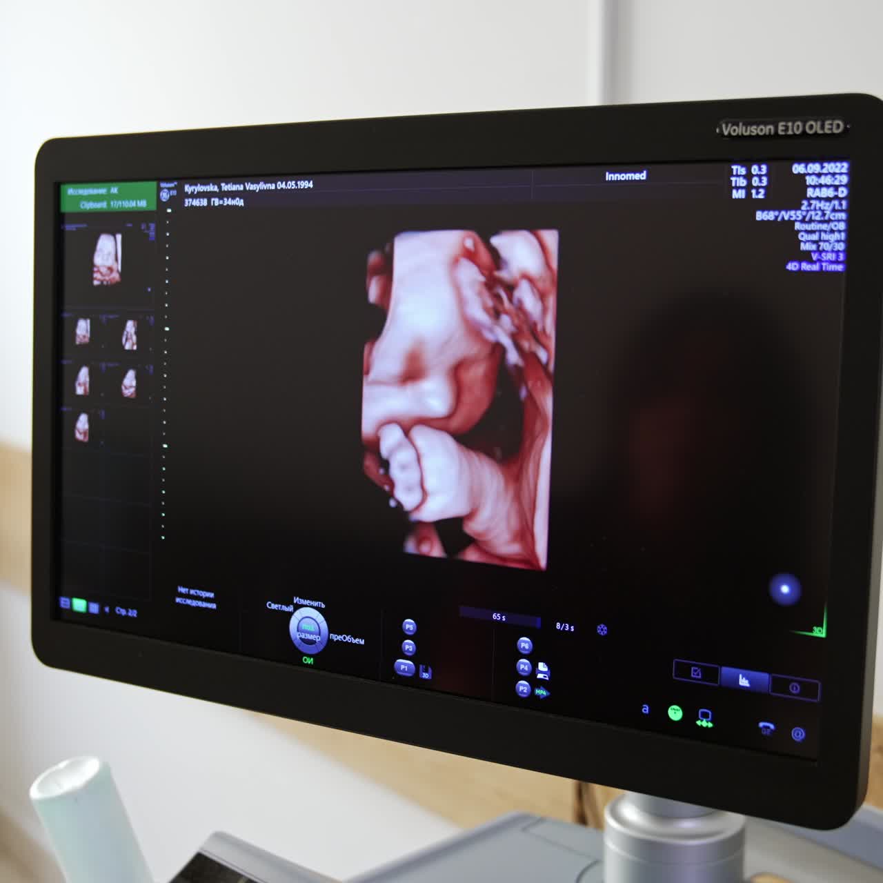 3d portrait of a baby in mom's womb at the screen of ultrasound machine. The image is rotated on the monitor in necessary direction